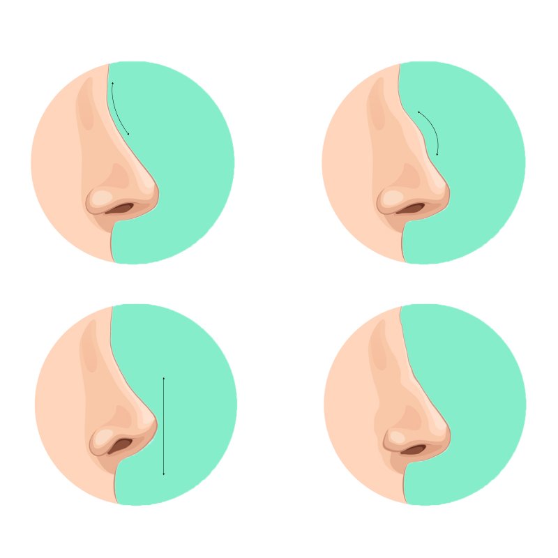 Nâng mũi cấu trúc sụn tai: Giải pháp hoàn hảo cho gương mặt tự ti