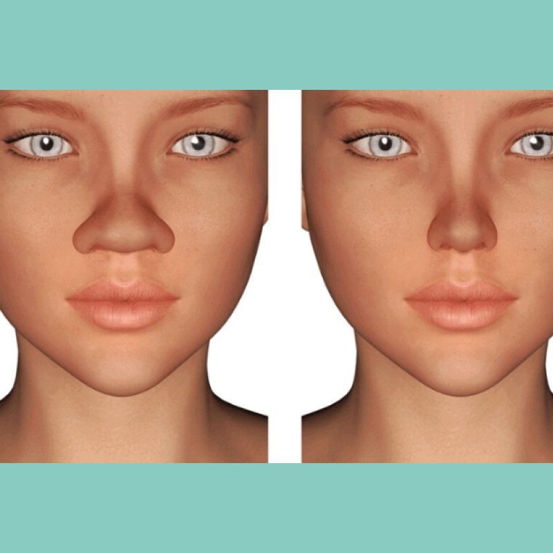 Thu nhỏ đầu mũi: Giải pháp tối ưu hài hòa gương mặt dành cho những người đầu mũi to