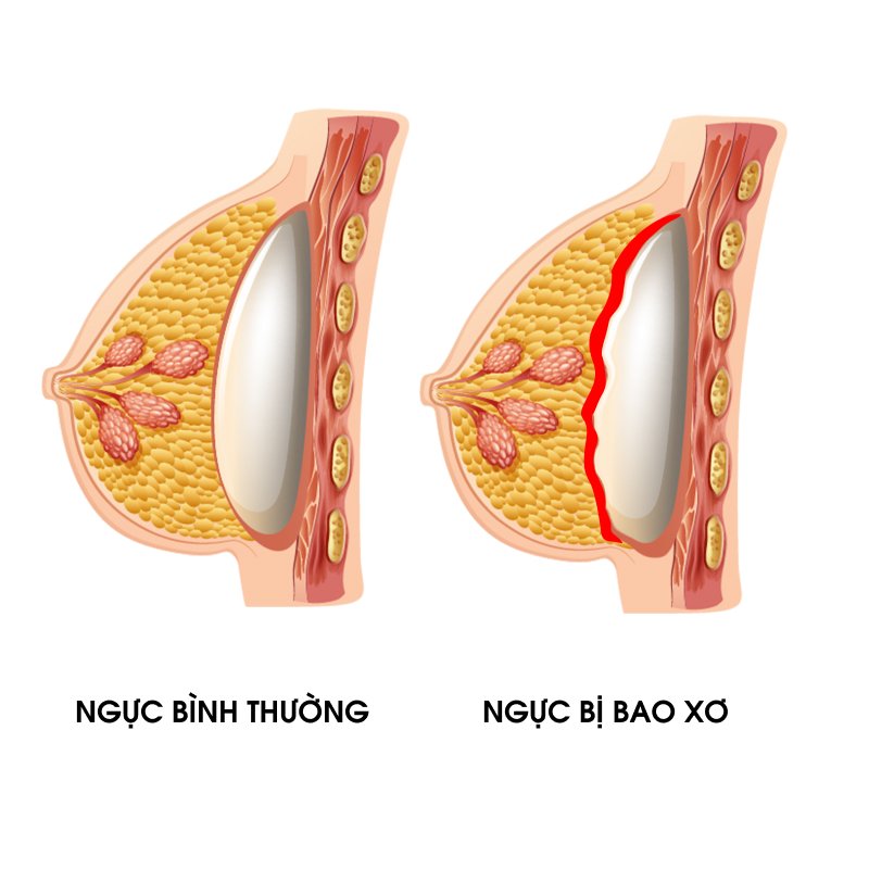 boc-tach-bao-xo-nguc-giai-phap-cuu-canh-cho-nhung-cap-nguc-cung-va-bien-dang