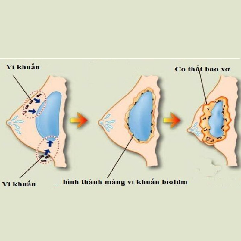 boc-tach-bao-xo-nguc-giai-phap-cuu-canh-cho-nhung-cap-nguc-cung-va-bien-dang