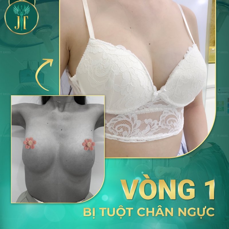 chinh-tuot-chan-nguc-giai-phap-khac-phuc-hieu-qua-cho-nguc-bi-tuot-chan-sau-khi-nang-nguc