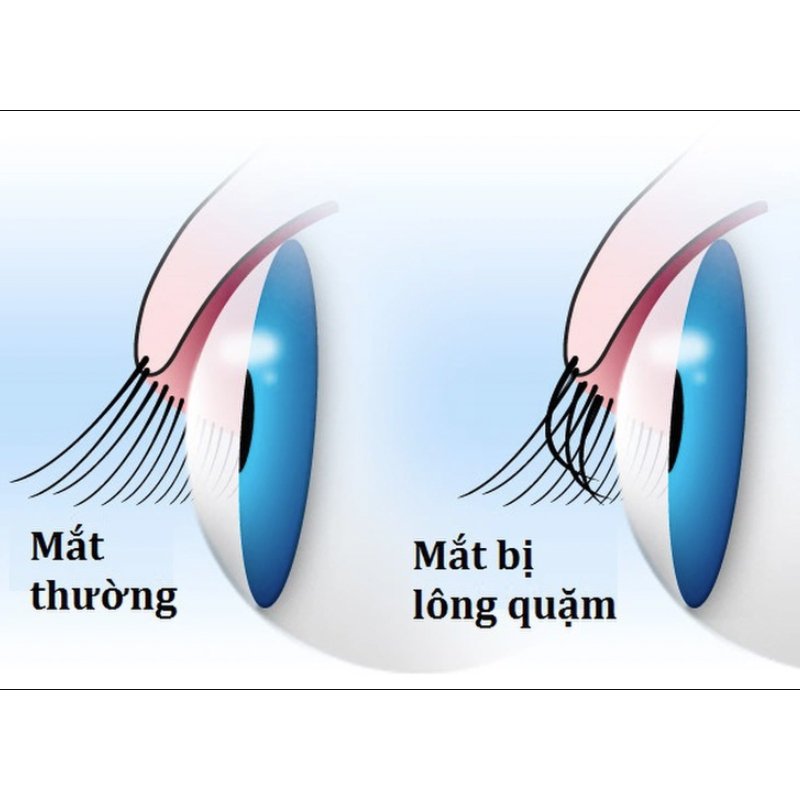 dieu-tri-long-quam-mi-va-nhung-dieu-can-biet