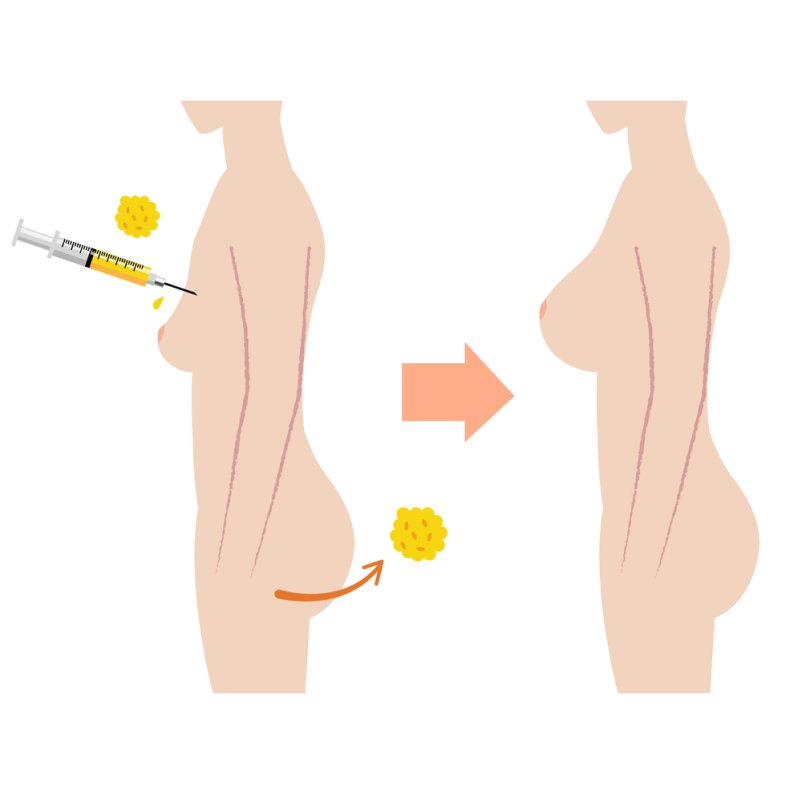 nang-nguc-nano-fat-phuong-phap-hoan-hao-cho-cac-co-nang-muon-so-huu-vong-1-tu-nhien