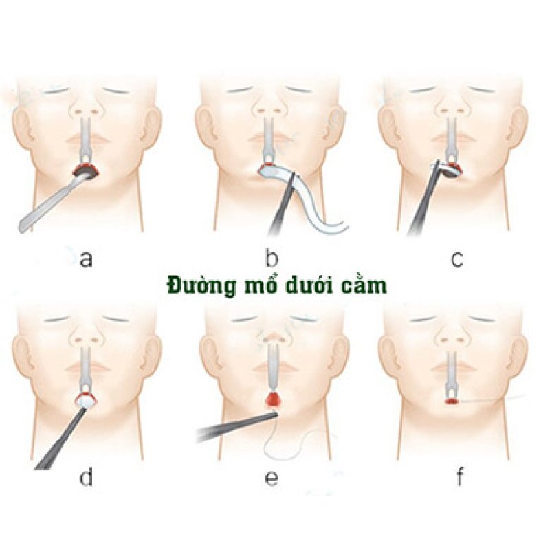 don-cam-ngoai-va-nhung-dieu-can-luu-y-truoc-khi-thuc-hien