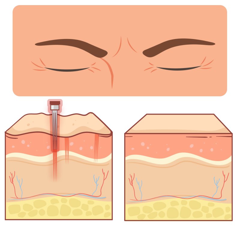 tiem-filler-chau-may-bi-quyet-xoa-nep-nhan-chau-may-nhanh-chong-hieu-qua-khong-xam-lan