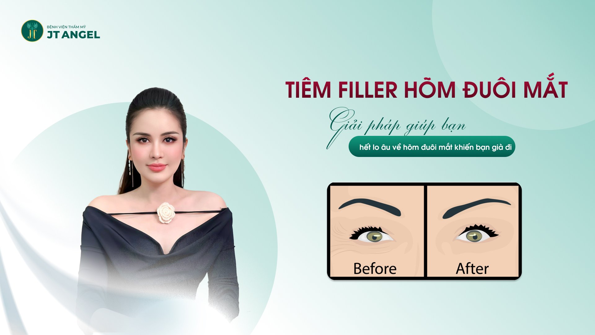 tiem-filler-hom-duoi-mat-giai-phap-giup-ban-het-lo-au-ve-hom-duoi-mat-khien-ban-gia-di