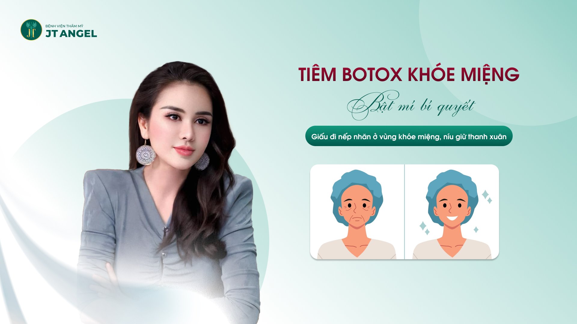 tiem-botox-khoe-mieng-bat-mi-bi-quyet-giau-di-nep-nhan-o-vung-khoe-mieng-niu-giu-thanh-xuan