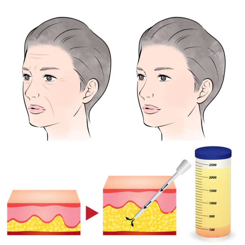 cay-mo-ranh-cuoi-xoa-tan-noi-am-anh-khuon-mat-gia-nua-do-ranh-cuoi-sau-va-nep-nhan