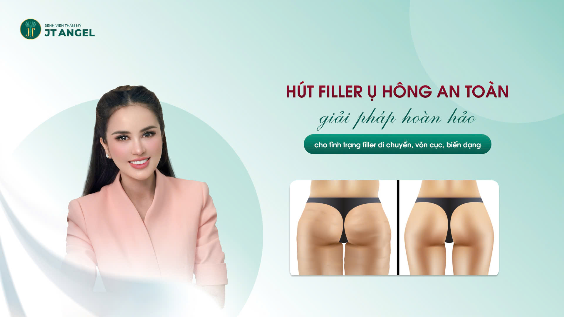 hut-filler-u-hong-an-toan-giai-phap-hoan-hao-cho-tinh-trang-filler-di-chuyen-von-cuc-bien-dang