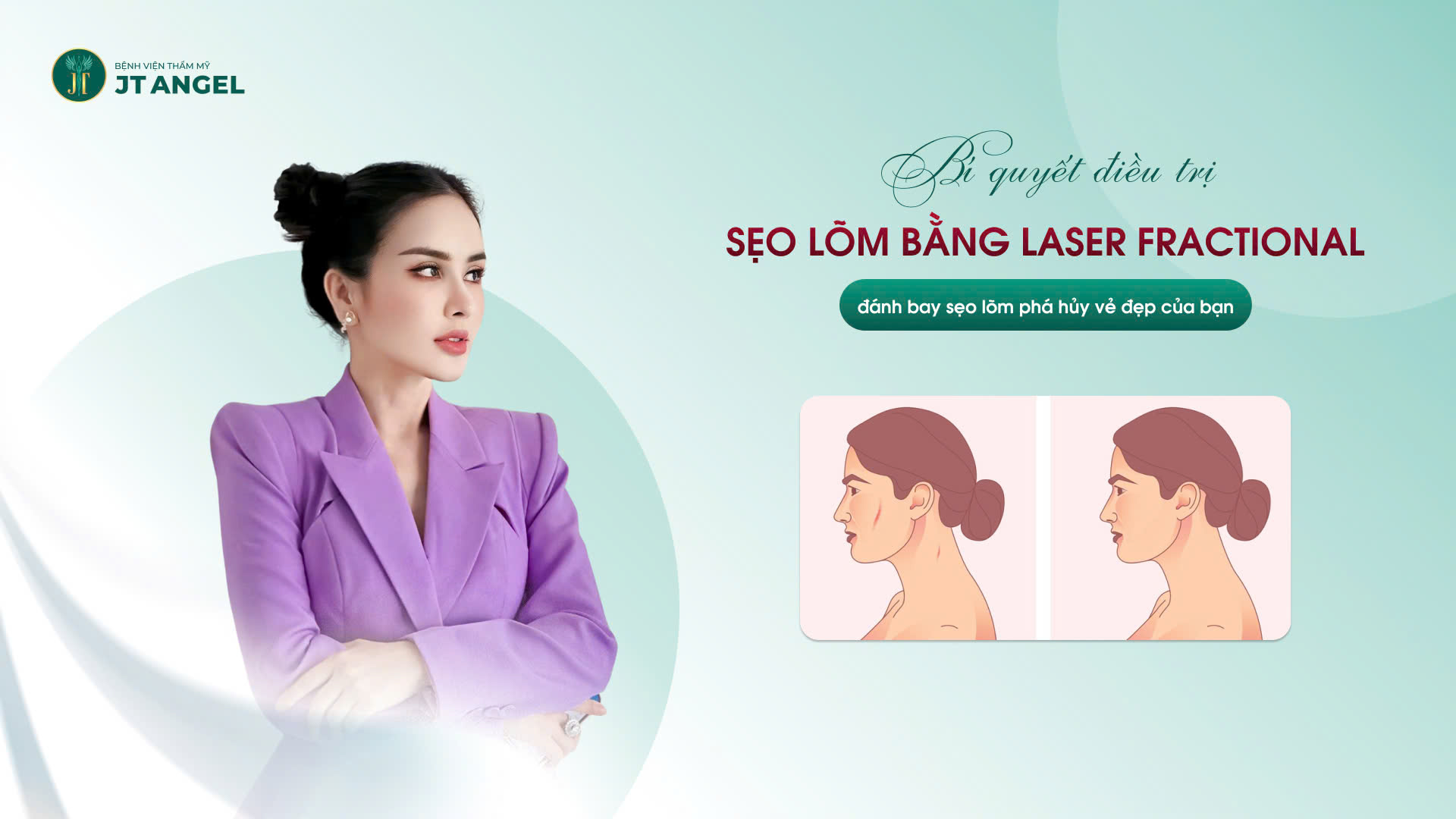 bi-quyet-dieu-tri-seo-lom-bang-laser-fractional-giup-ban-lay-lai-lan-da-tu-tin-danh-bay-seo-lom-pha-huy-ve-dep-cua-ban