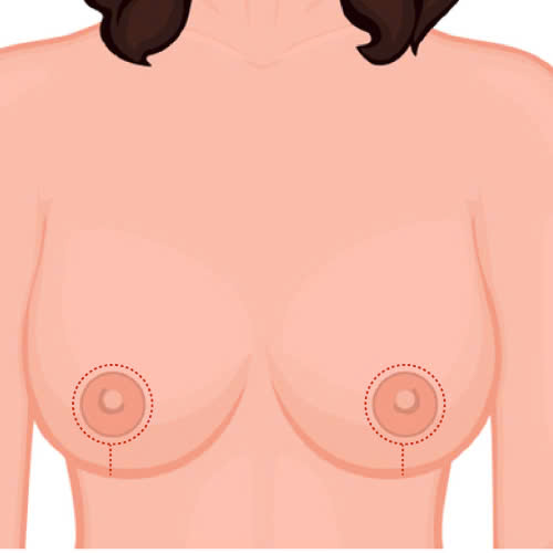 seo-sau-nang-nguc-nguyen-nhan-cach-phong-ngua-va-giam-thieu-hieu-qua