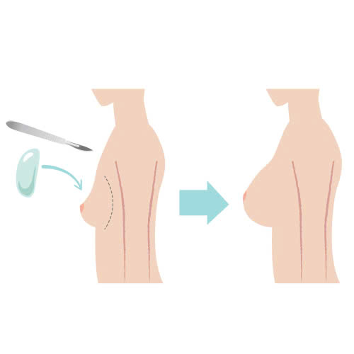 Cẩn trọng chăm sóc vết thương sau phẫu thuật nâng ngực