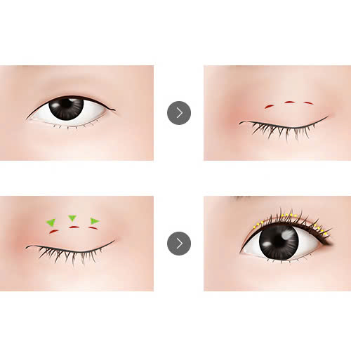 cach-cham-soc-mi-mat-sau-khi-cat-chi-nhung-luu-y-quan-trong-de-qua-trinh-hoi-phuc-dien-ra-suon-se