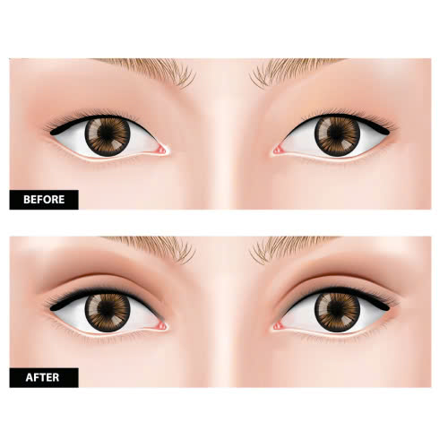 cach-cham-soc-mi-mat-sau-khi-cat-chi-nhung-luu-y-quan-trong-de-qua-trinh-hoi-phuc-dien-ra-suon-se