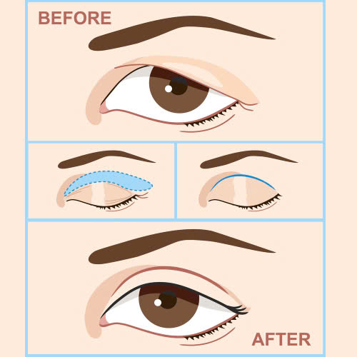 cat-mat-bao-lau-duoc-trang-diem-giai-dap-moi-thac-mac-sau-phau-thuat