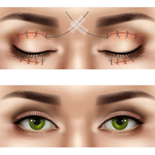 cat-mat-bao-lau-het-sung-nhung-dieu-ban-can-biet-de-phuc-hoi-nhanh-chong