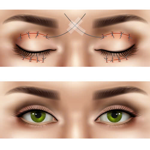 cat-mat-kieng-thit-bo-bao-lau-huong-dan-chi-tiet-sau-phau-thuat