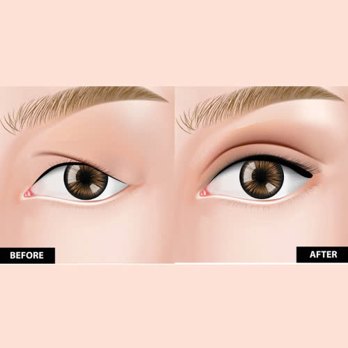 cat-mat-kieng-thit-bo-bao-lau-huong-dan-chi-tiet-sau-phau-thuat