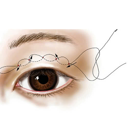 cat-mi-mat-bi-seo-loi-phai-lam-sao-nguyen-nhan-va-cach-xu-ly-hieu-qua