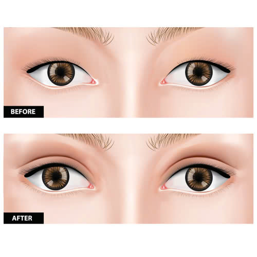 cat-mi-mat-bi-seo-loi-phai-lam-sao-nguyen-nhan-va-cach-xu-ly-hieu-qua