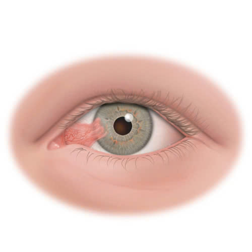 cat-mong-mat-kieng-bao-lau-nhung-dieu-ban-can-biet-de-hoi-phuc-nhanh-chong