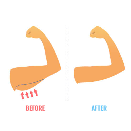 hut-mo-bap-tay-bao-lau-tap-gym-duoc-nhung-dieu-can-biet