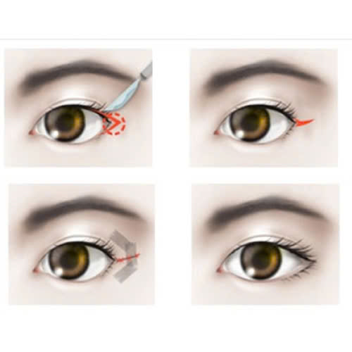 mo-goc-mat-ngoai-bao-lau-thi-lanh-tim-hieu-qua-trinh-phuc-hoi-va-cham-soc-hieu-qua