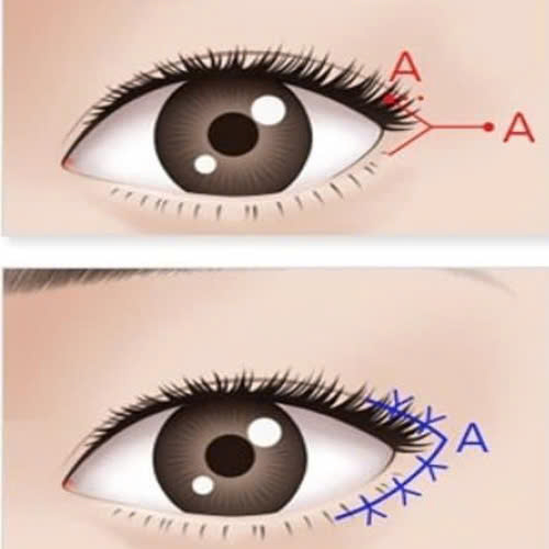 mo-goc-mat-ngoai-bao-lau-thi-lanh-tim-hieu-qua-trinh-phuc-hoi-va-cham-soc-hieu-qua