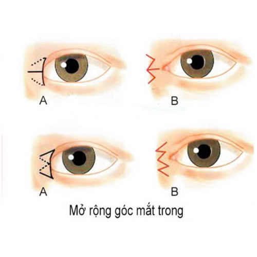 seo-mo-goc-mat-trong-nhung-dieu-ban-can-biet-va-cach-phong-ngua