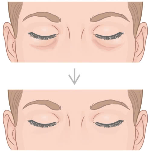 cach-cham-soc-sau-khi-cay-mo-hoc-mat