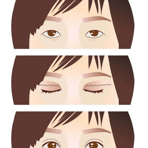 cat-mat-2-mi-gia-bao-nhieu-tien-tim-hieu-chi-tiet-ve-chi-phi-va-quy-trinh