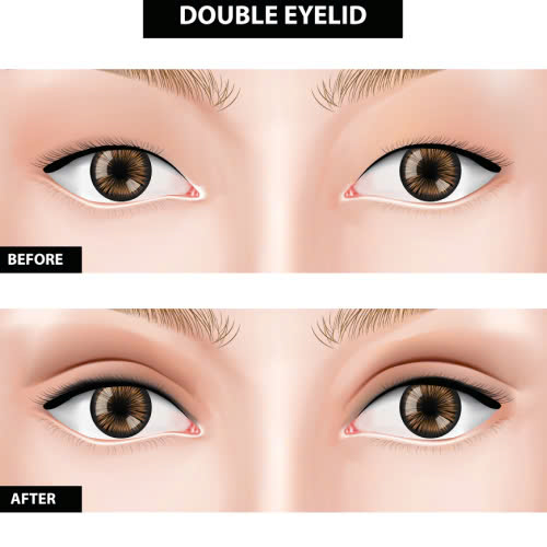 cat-mat-an-mang-duoc-khong-nhung-dieu-can-biet-sau-khi-phau-thuat