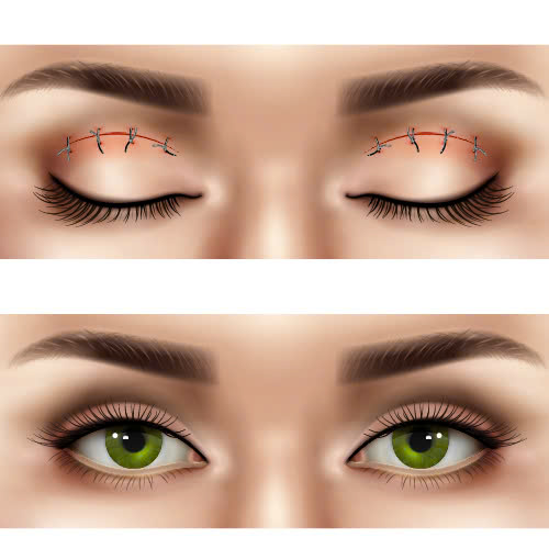 cat-mat-an-mang-duoc-khong-nhung-dieu-can-biet-sau-khi-phau-thuat