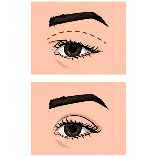 cat-mi-an-dau-hu-duoc-khong-giai-dap-chi-tiet-cho-qua-trinh-hoi-phuc