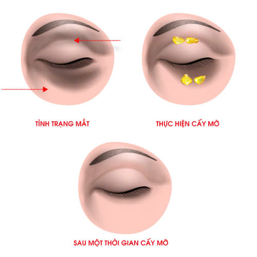 cay-mo-hoc-mat-bao-lau-thi-het-sung-giai-dap-chi-tiet-cach-cham-soc-hieu-qua
