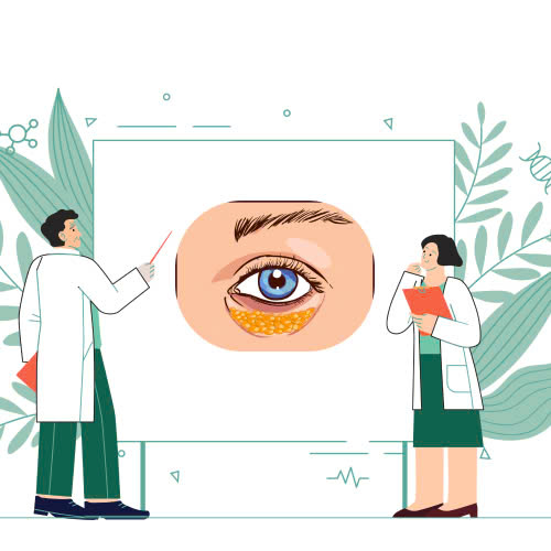 cay-mo-hoc-mat-bao-lau-thi-on-dinh-tat-tan-tat-nhung-dieu-can-biet