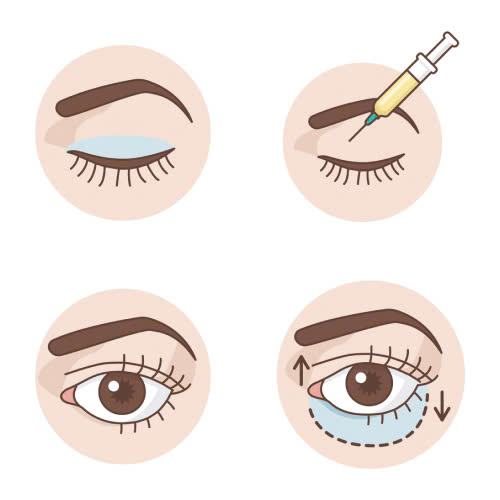 cay-mo-hoc-mat-co-nguy-hiem-khong-giai-dap-tu-chuyen-gia