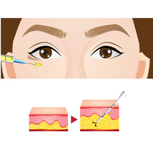cay-mo-hoc-mat-sau-duy-tri-duoc-bao-lau-giai-dap-chi-tiet