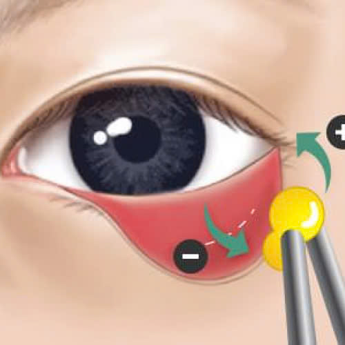 cay-mo-hoc-mat-sau-duy-tri-duoc-bao-lau-giai-dap-chi-tiet