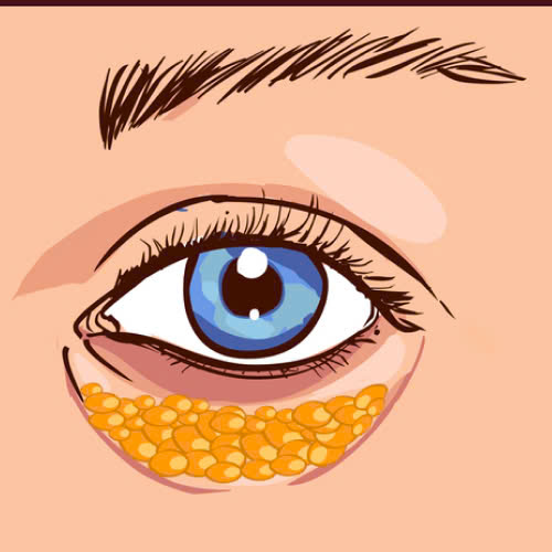 chi-phi-cay-mo-hoc-mat-gia-bao-nhieu-va-nhung-dieu-can-biet