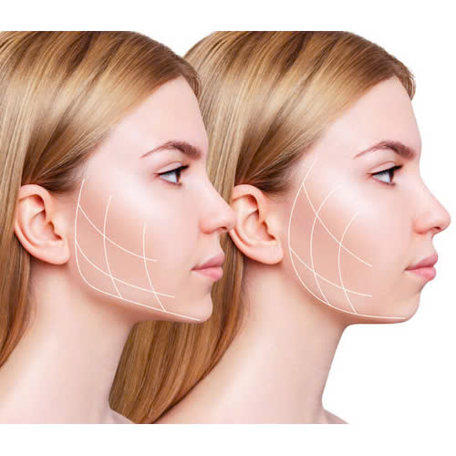 co-nen-tiem-botox-gon-ham-khong-ai-phu-hop-voi-phuong-phap-nay