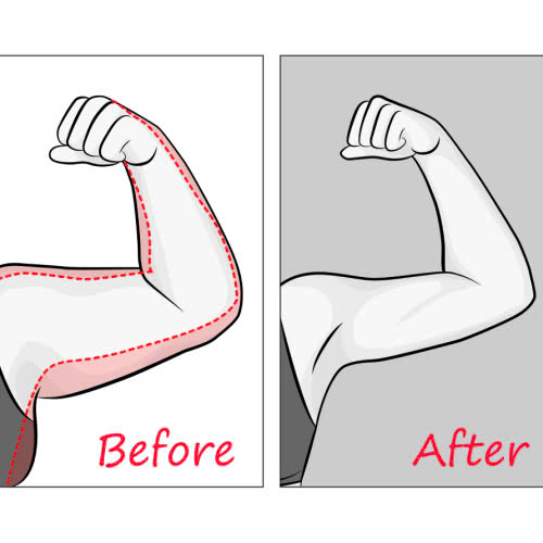 co-nen-tiem-botox-thon-gon-bap-tay-su-that-ban-can-biet-truoc-khi-quyet-dinh