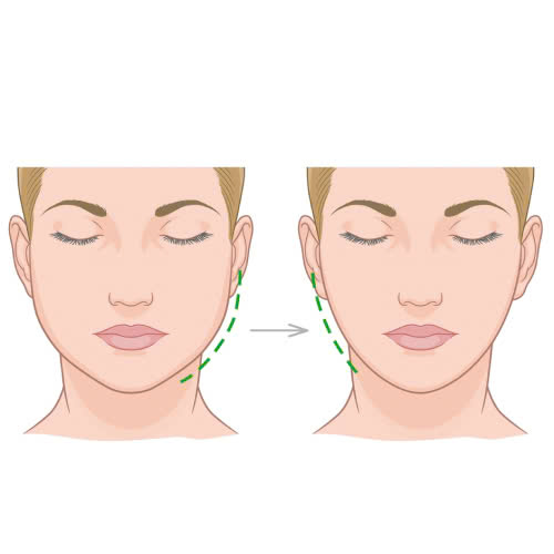 sau-khi-tiem-botox-thon-gon-ham-nen-kieng-gi-huong-dan-chi-tiet-cho-cac-chi-em