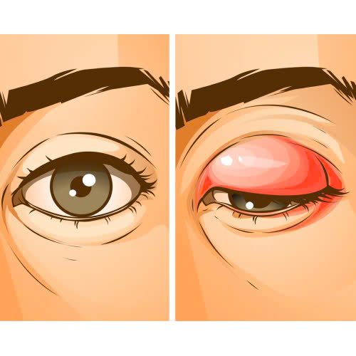 tiem-botox-bi-sup-mi-mat-nguyen-nhan-cach-phong-tranh-va-khac-phuc