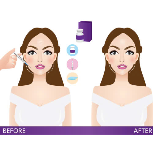 tiem-botox-giu-duoc-bao-lau-giai-dap-chi-tiet-cho-nguoi-moi