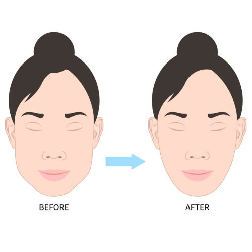 tiem-botox-gon-ham-giu-duoc-bao-lau-nhung-yeu-to-anh-huong-den-thoi-gian-duy-tri