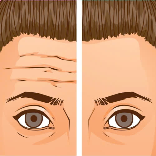 tiem-botox-xoa-nhan-tran-gia-bao-nhieu-cap-nhat-chi-tiet-moi