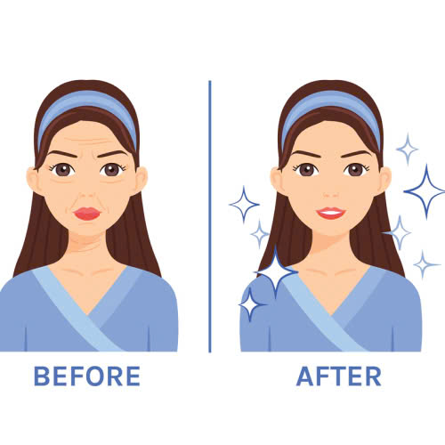 tiem-filler-an-mam-tom-duoc-khong-kieng-bao-lau-la-tot