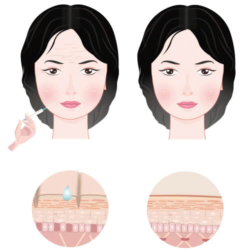 tiem-filler-an-oc-duoc-khong-nhung-dieu-can-biet-sau-khi-tiem-filler