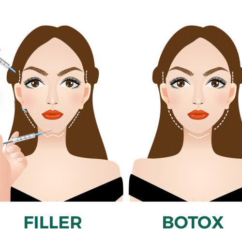 tiem-filler-va-botox-cai-nao-tot-hon-giai-ma-su-khac-biet-va-lua-chon-phu-hop